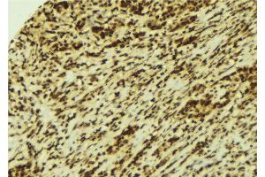 ABIN6269360 at 1/100 staining Human breast cancer tissue by IHC-P. (STAT4 antibody  (C-Term))