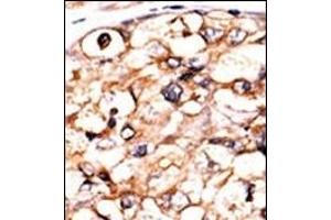 Formalin-fixed and paraffin-embedded human cancer tissue reacted with the primary antibody, which was peroxidase-conjugated to the secondary antibody, followed by AEC staining. (PGK2 antibody  (N-Term))