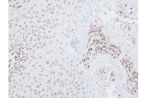 IHC-P Image Immunohistochemical analysis of paraffin-embedded Cal27 xenograft, using NRF2, antibody at 1:500 dilution. (NRF2 antibody  (Internal Region))