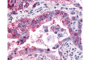 Anti-GPR1 antibody IHC of human Lung, Adenocarcinoma. (G Protein-Coupled Receptor 1 antibody  (C-Term))