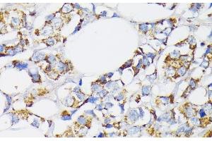Immunohistochemistry of paraffin-embedded Human breast cancer using USP33 Polyclonal Antibody at dilution of 1:100 (40x lens). (USP33 antibody)