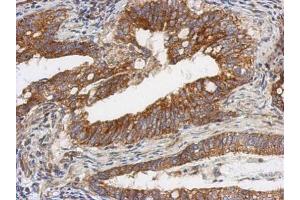 IHC-P Image Immunohistochemical analysis of paraffin-embedded human gastric cancer, using TSFM, antibody at 1:500 dilution.