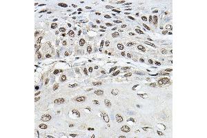 Immunohistochemistry of paraffin-embedded human esophageal cancer using TRRAP Rabbit pAb (ABIN7270906) at dilution of 1:100 (40x lens). (TRRAP antibody)