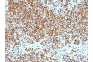 Formalin-fixed, paraffin-embedded human Lymphoma stained with CD45 Monoclonal Antibody (SPM569+SPM570). (CD45 antibody)