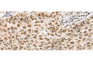 Immunohistochemistry of paraffin-embedded Human esophagus cancer tissue using PRPF40A Polyclonal Antibody at dilution of 1:60(x200) (PRPF40A antibody)