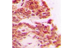 Immunohistochemical analysis of Carboxypeptidase A1 staining in human breast cancer formalin fixed paraffin embedded tissue section.