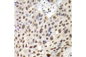 Immunohistochemistry of paraffin-embedded human lung cancer using GNB2L1 antibody. (GNB2L1 antibody)