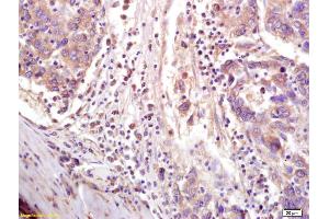 Formalin-fixed and paraffin embedded human lung carcinoma labeled with Anti-CTCF Polyclonal Antibody, Unconjugated (ABIN703976) at 1:200 followed by conjugation to the secondary antibody and DAB staining. (CTCF antibody  (AA 451-550))