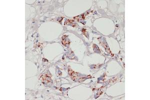 Immunohistochemistry of paraffin-embedded human mammary cancer using  antibody (ABIN6129863, ABIN6136456, ABIN6136457 and ABIN6215371) at dilution of 1:100 (40x lens). (Acsl3 antibody  (AA 42-300))