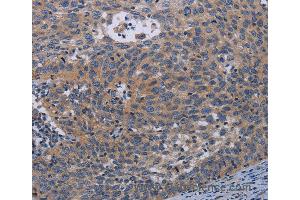 Immunohistochemistry of Human cervical cancer using PAPPA Polyclonal Antibody at dilution of 1:50 (PAPPA antibody)