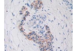 Detection of CYR61 in Human Pancreatic cancer Tissue using Polyclonal Antibody to Cysteine Rich Protein, Angiogenic Inducer 61 (CYR61) (CYR61 antibody  (AA 178-381))