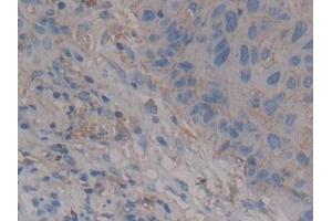 Detection of SDC1 in Human Lung cancer Tissue using Polyclonal Antibody to Syndecan 1 (SDC1) (Syndecan 1 antibody  (AA 23-253))