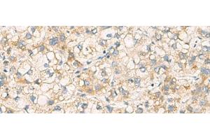 Immunohistochemistry of paraffin-embedded Human liver cancer tissue using PAFAH1B3 Polyclonal Antibody at dilution of 1:70(x200) (PAFAH1B3 antibody)