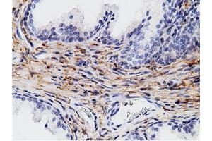 Immunohistochemical staining of paraffin-embedded Human liver tissue using anti-CD80 mouse monoclonal antibody. (CD80 antibody)