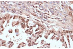 Immunohistochemistry of paraffin-embedded Human lung cancer using RAD50 Polyclonal Antibody at dilution of 1:100 (40x lens). (RAD50 antibody)