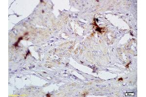 Formalin-fixed and paraffin embedded human cervical carcinoma labeled with Anti-CD72/Ly-32 Polyclonal Antibody, Unconjugated (ABIN741420) at 1:200 followed by conjugation to the secondary antibody and DAB staining