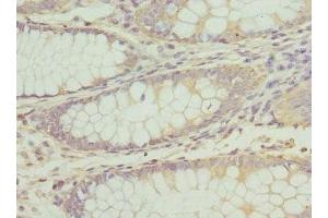 Immunohistochemistry of paraffin-embedded human colon cancer using ABIN7163515 at dilution of 1:100 (ATP2B2 antibody  (AA 1-80))