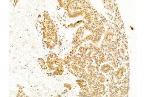 ABIN6255488 and ABIN6267309 at 1/100 staining Human lung cancer by IHC-P. (C-JUN antibody  (pSer73))