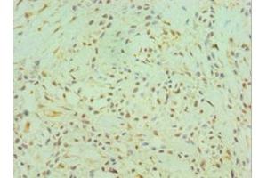Immunohistochemistry of paraffin-embedded human breast cancer using ABIN7147014 at dilution of 1:100 (Cathepsin K antibody  (AA 115-329))