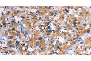 Immunohistochemistry of paraffin-embedded Human thyroid cancer using COMP Polyclonal Antibody at dilution of 1:50 (COMP antibody)