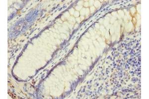 Immunohistochemistry of paraffin-embedded human colon cancer using ABIN7174455 at dilution of 1:100 (UBE2G2 antibody  (AA 1-165))