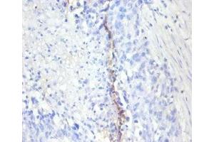 Immunohistochemistry of paraffin-embedded human bladder cancer using ABIN7164742 at dilution of 1:100 (Ki-67 antibody  (AA 3120-3256))