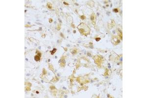 Immunohistochemistry of paraffin-embedded human brain astrocytoma using FCN1 Antibody (ABIN5973958) at dilution of 1/100 (40x lens). (FCN1 antibody)
