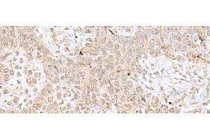 Immunohistochemistry of paraffin-embedded Human ovarian cancer tissue using RPL35 Polyclonal Antibody at dilution of 1:70(x200) (RPL35 antibody)