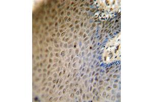 SREBF2 antibody (Center) (ABIN654630 and ABIN2844326) immunohistochemistry analysis in formalin fixed and paraffin embedded human skin carcinoma followed by peroxidase conjugation of the secondary antibody and DAB staining. (SREBF2 antibody  (AA 399-427))