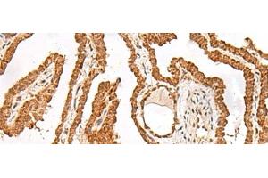 Immunohistochemistry of paraffin-embedded Human thyroid cancer tissue using FER Polyclonal Antibody at dilution of 1:90(x200) (FER antibody)