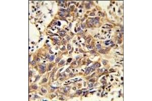 Formalin-fixed and paraffin-embedded human lung carcinoma reacted with CAT Antibody (Center), which was peroxidase-conjugated to the secondary antibody, followed by DAB staining. (Catalase antibody  (AA 152-180))