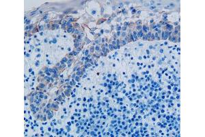 IHC-P analysis of skin cancer tissue, with DAB staining. (PLAA antibody  (AA 367-468))