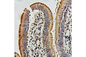 Immunohistochemical analysis of HIP1 staining in human colon cancer formalin fixed paraffin embedded tissue section. (HIP1 antibody)
