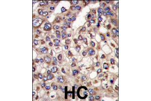 Formalin-fixed and paraffin-embedded human hepatocellular carcinoma reacted with MTMR4 polyclonal antibody  , which was peroxidase-conjugated to the secondary antibody, followed by DAB staining . (MTMR4 antibody  (C-Term))