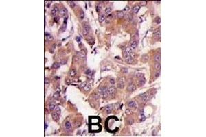 Formalin-fixed and paraffin-embedded human breast carcinoma tissue reacted with MEK1 Antibody (N-term) (ABIN1882177 and ABIN2842020) , which was peroxidase-conjugated to the secondary antibody, followed by DAB staining. (MEK1 antibody  (N-Term))