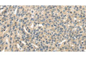 Immunohistochemistry of paraffin-embedded Human esophagus cancer tissue using RASA2 Polyclonal Antibody at dilution 1:45 (RASA2 antibody)