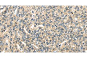Immunohistochemistry of paraffin-embedded Human esophagus cancer tissue using RASA2 Polyclonal Antibody at dilution 1:45
