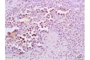 Formalin-fixed and paraffin embedded mouse lymphoma tissue labeled with Anti-FRA2/FOSL2 Polyclonal Antibody, Unconjugated (ABIN673104) at 1:200 followed by conjugation to the secondary antibody and DAB staining