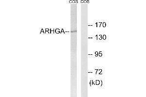 Immunohistochemistry analysis of paraffin-embedded human breast carcinoma tissue using ARHGEF10 antibody. (ARHGEF10 antibody  (Internal Region))