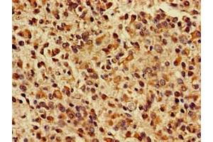 Immunohistochemistry of paraffin-embedded human glioma using ABIN7157603 at dilution of 1:100 (KIF17 antibody  (AA 500-777))