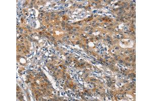 Immunohistochemistry of Human gastric cancer using ANP32C Polyclonal Antibody at dilution of 1:15