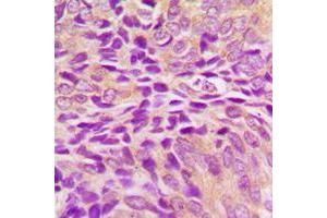 Immunohistochemical analysis of GRP75 staining in human breast cancer formalin fixed paraffin embedded tissue section. (HSPA9 antibody  (C-Term))