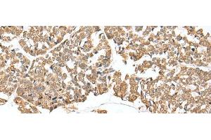Immunohistochemistry of paraffin-embedded Human esophagus cancer tissue using NDUFB3 Polyclonal Antibody at dilution of 1:25(x200) (NDUFB3 antibody)