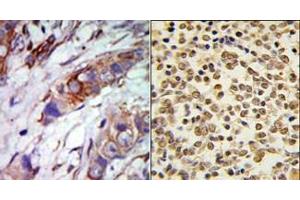 (LEFT)Formalin-fixed and paraffin-embedded human cancer tissue reacted with the primary antibody, which was peroxidase-conjugated to the secondary antibody, followed by AEC staining. (MAPK7 antibody  (C-Term))