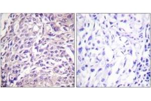 Immunohistochemistry analysis of paraffin-embedded human breast carcinoma tissue, using FOXO1A (Ab-329) Antibody. (FOXO1 antibody  (AA 295-344))