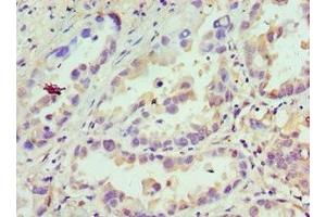 Immunohistochemistry of paraffin-embedded human lung cancer using ABIN7145712 at dilution of 1: 100 (CDCA8 antibody  (AA 1-280))