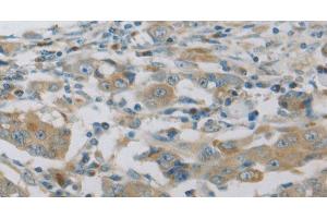 Immunohistochemistry of paraffin-embedded Human breast cancer using MAP2K6 Polyclonal Antibody at dilution of 1:30 (MAP2K6 antibody)