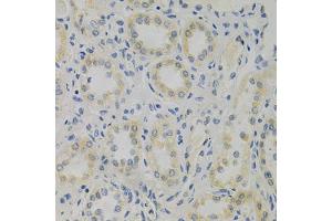 Immunohistochemistry of paraffin-embedded human kidney cancer using STMN1 Antibody. (Stathmin 1 antibody)