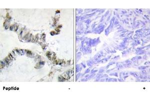 Immunohistochemistry analysis of paraffin-embedded human colon carcinoma tissue, using HMGXB3 polyclonal antibody .