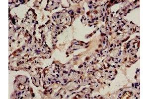 Immunohistochemistry analysis of human lung cancer using ABIN7145820 at dilution of 1:100 (BRD8 antibody  (AA 641-859))